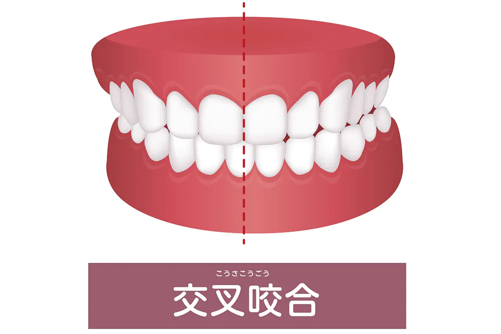 交叉咬合（クロスバイト）