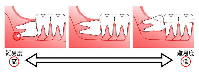 親知らずの抜歯